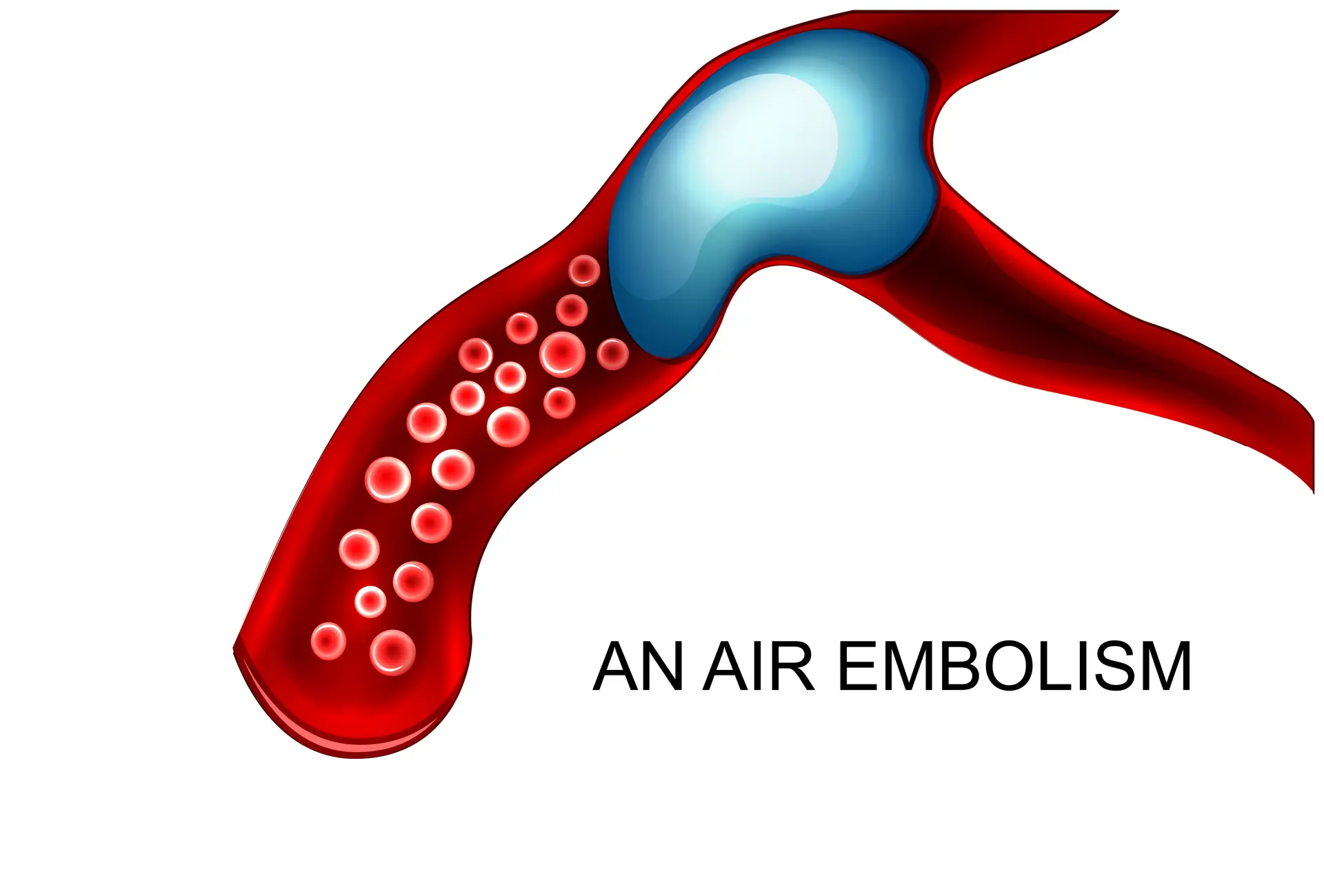 Air embolism